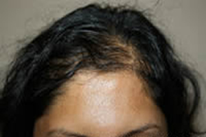 Female Hair Loss Treatment
