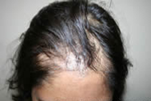 Female Pafter Hair Loss