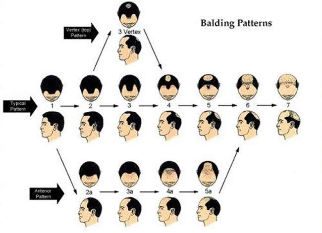 Male Pattern Baldness