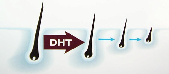 DHT And Hair Loss
